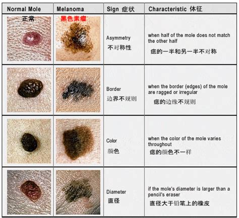 身上的痣|一图读懂：什么样的痣易癌变？